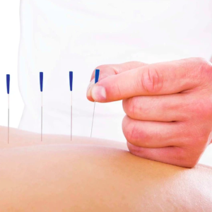 Kỹ thuật Châm cứu Cơ bản
